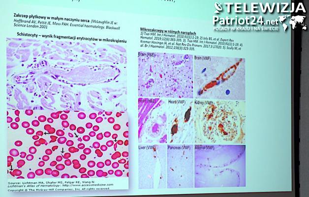 [VIDEO] W tej chorobie liczy się dosłownie każda godzina. W Polsce jej rozpoznanie wciąż jest problemem, a bez diagnozy 90 proc. chorych umrze w ciągu dwóch tygodni